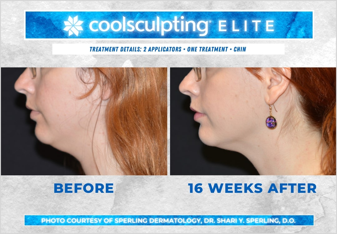 Black Friday Sale: CoolSculpting Elite Chin Fat Package (save €351)