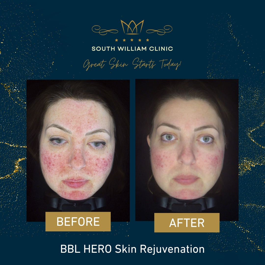 Summer Stax Laser Duo: BBL + HALO Skin Rejuvenation (save up to €601)