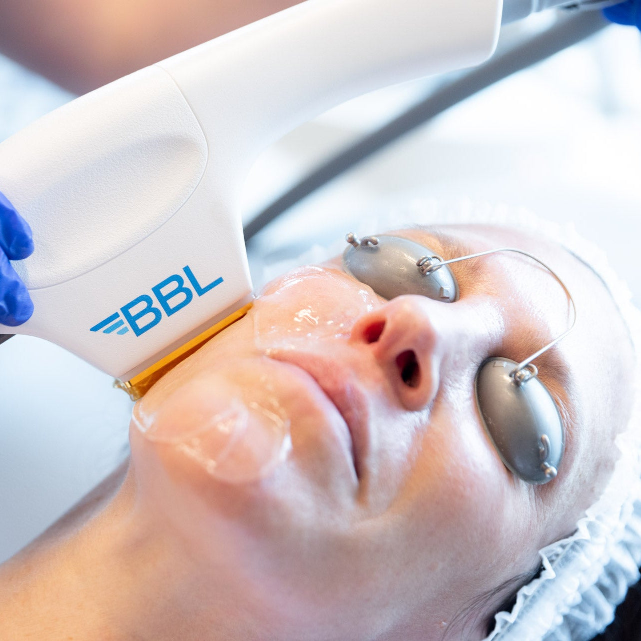 MOXI Laser + BBL Hero Skin Rejuvenation