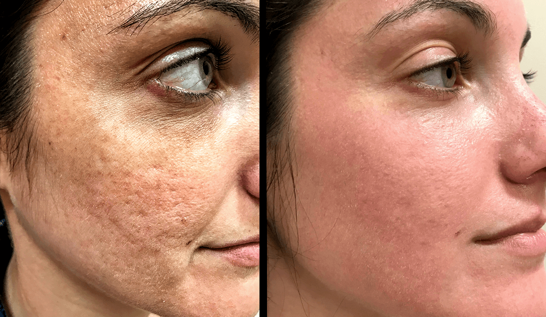 Summer Stax Laser Duo: BBL + HALO Skin Rejuvenation (save up to €601)