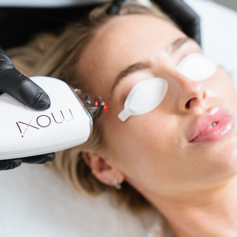 MOXI Laser Skin Rejuvenation Single Session (save €101)