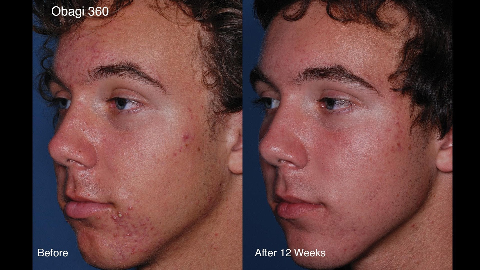 Obagi CLENZIderm Daily Foaming Cleanser 118ml