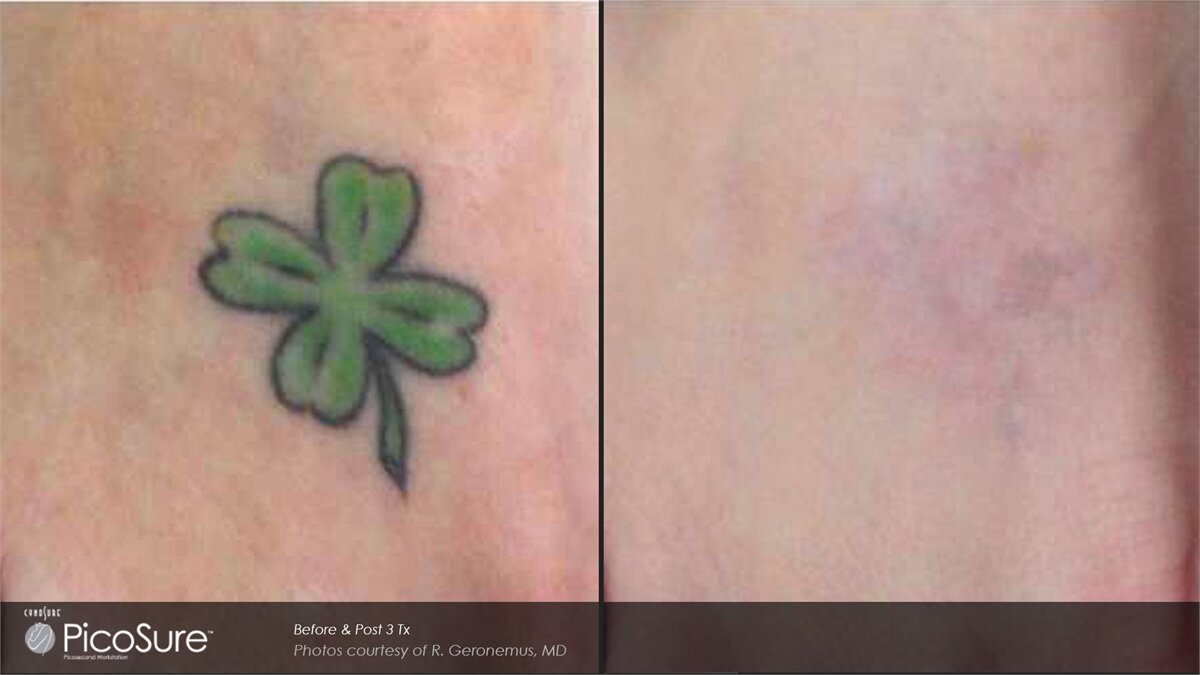 Picosure Laser Tattoo Removal (save up to €501)