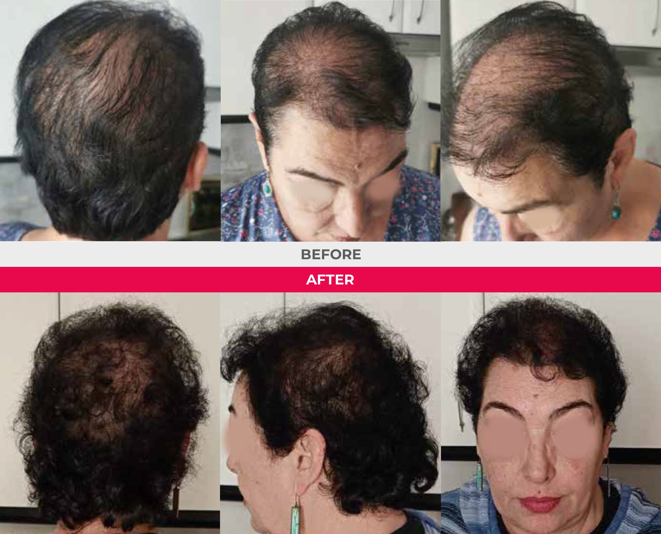 Purasomes Exosome Treatment for face or scalp (save up to €356)