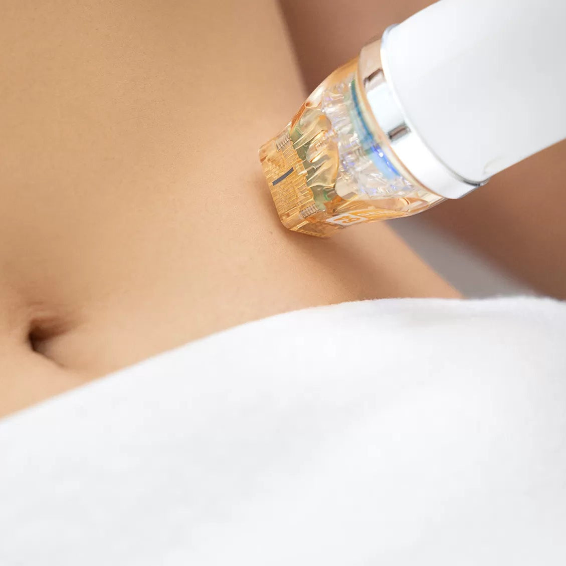 Secret RF +Microneedling Skin Rejuvenation & Tightening for Body Course of 4 (save up to €1,551)