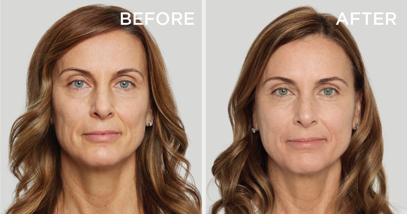 Sculptra or Radiesse Biostimulators for Collagen Stimulation and Subtle Volume (save €201)
