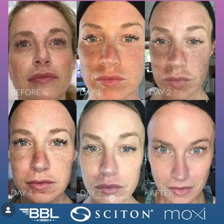 MOXI Laser + BBL Hero Skin Rejuvenation