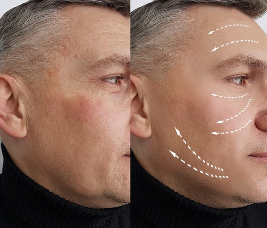 Anti-Wrinkle 2/3 Areas (save up to €151)