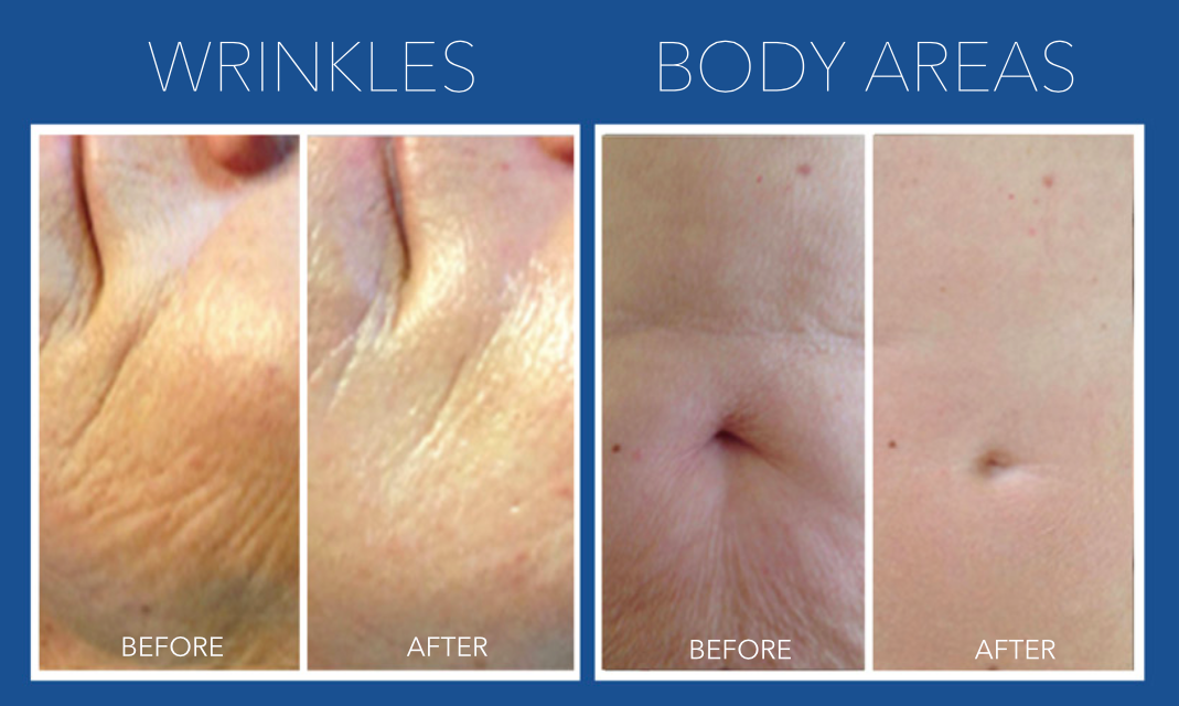 Black Friday Sale: Dermapen Deluxe Microneedling with Uber Peel & LED Course of 2 (save €251)