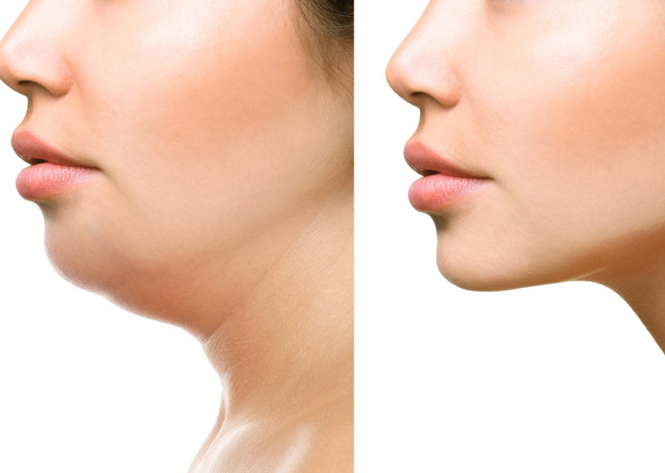 Black Friday Sale: CoolSculpting Elite Chin Fat Package (save €351)