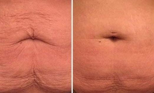 Morpheus8 Deep RF Microneedling for Body Area course of 3 (save up to €2251)