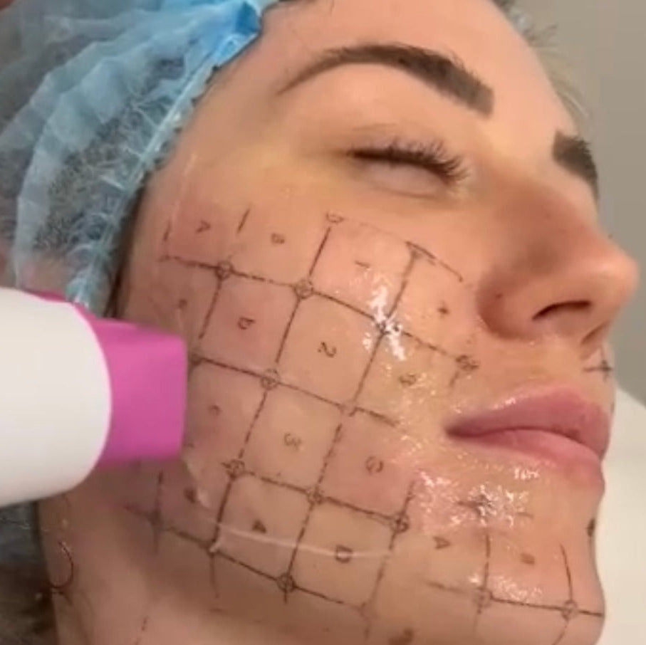 Thermage FLX RF Anti-Ageing Skin Tightening Treatment (save up to €501)