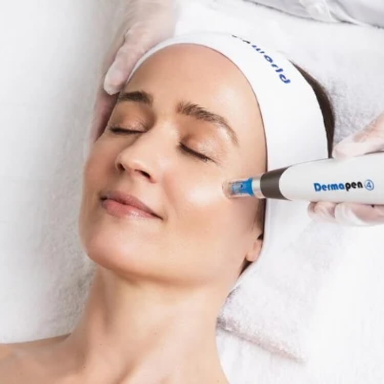 Signature 5-Step Advanced Facial: HydraFacial, BBL Laser, Microneedling, Uber Peel, & LED