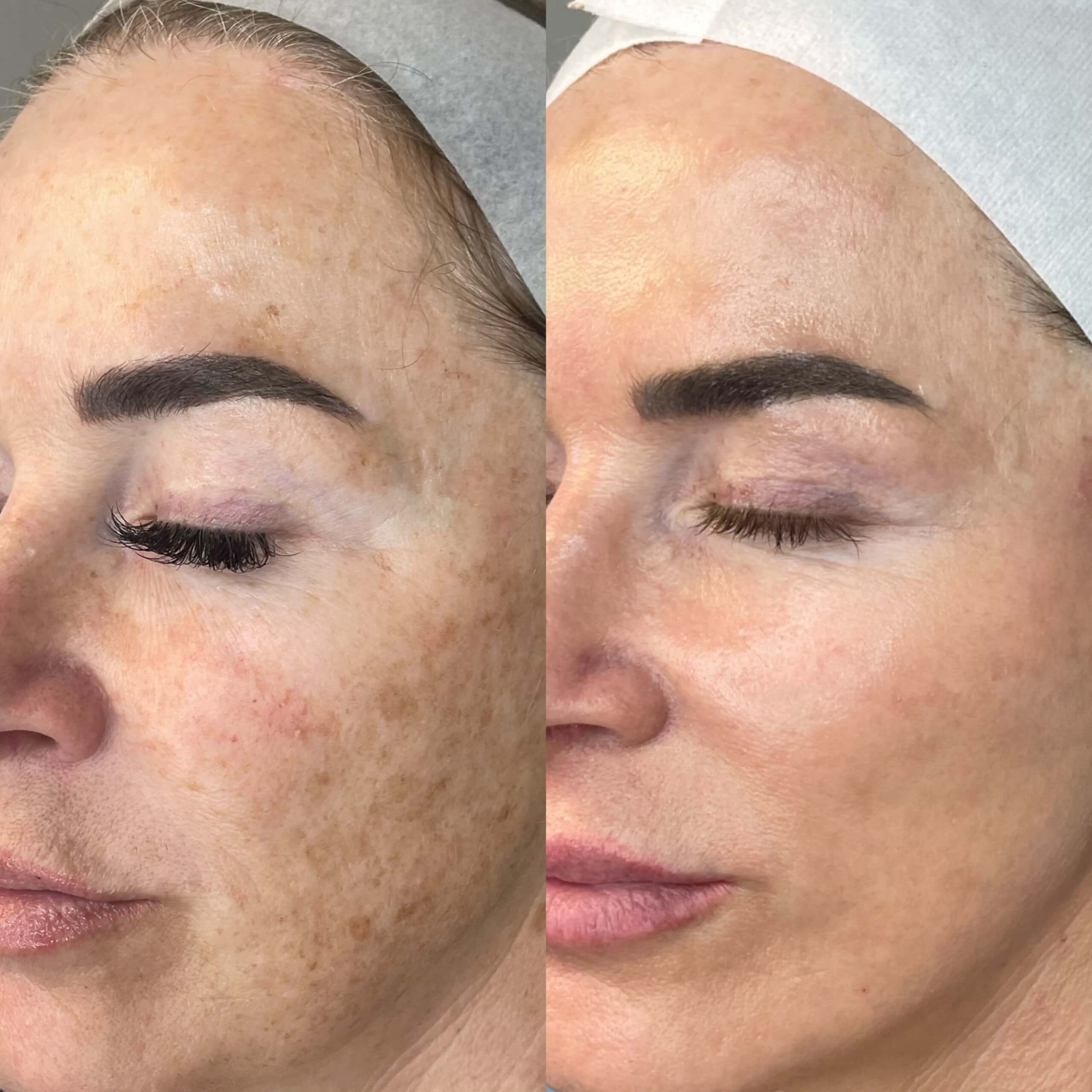 MOXI Laser + BBL Hero Skin Rejuvenation