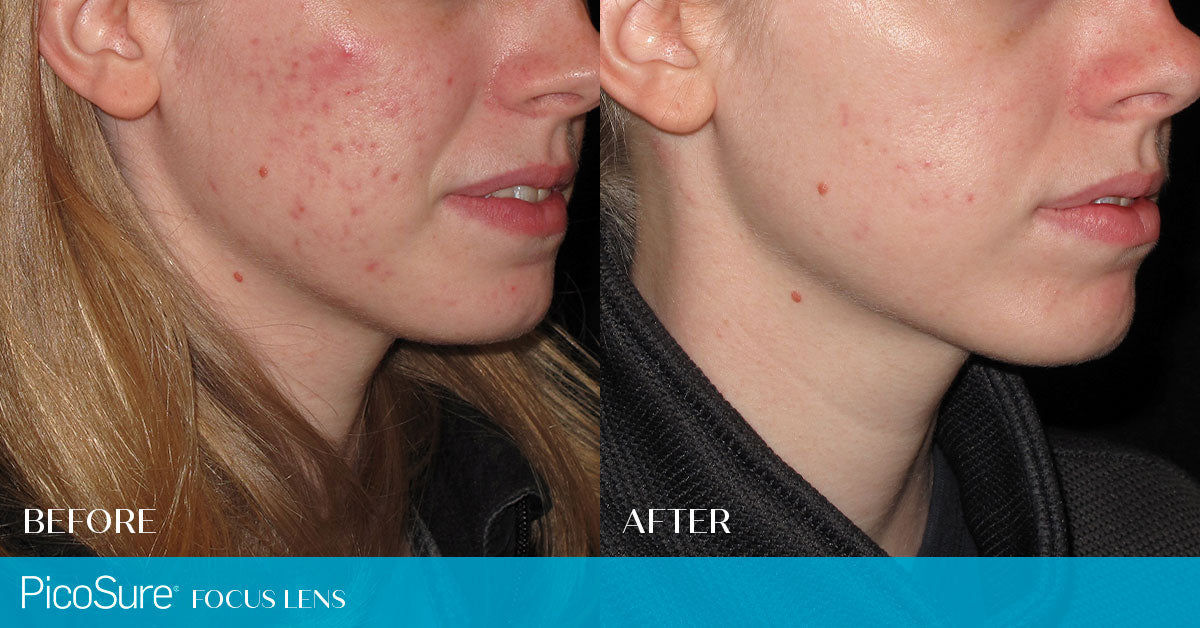PicoSure Laser Skin Rejuvenation for Pigmentation & Melasma Course of 3 (save up to €701)