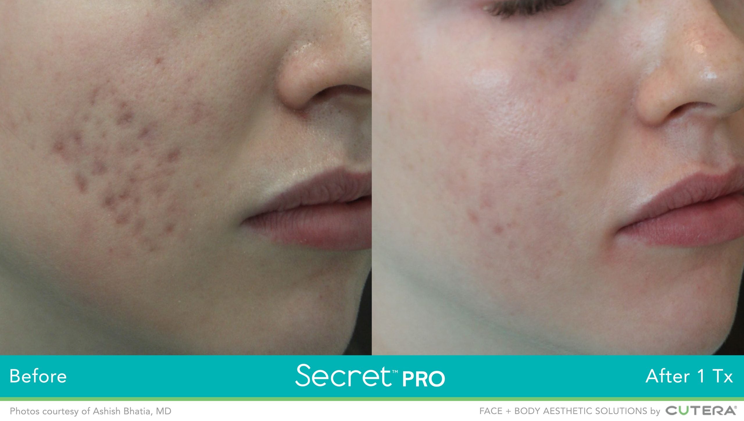 Cutera Secret PRO CO2 Ablative Laser Resurfacing (save up to €751)