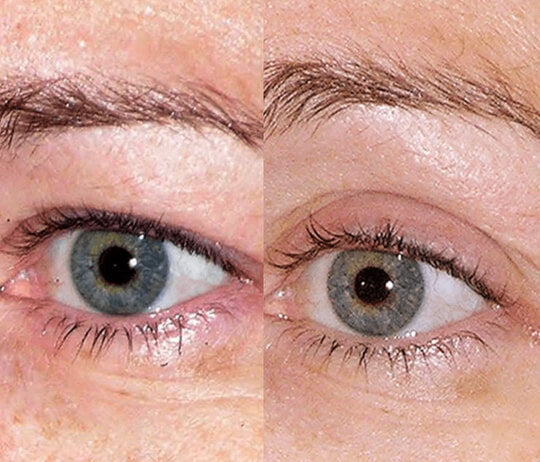 Thermage RF Anti-Ageing Skin Tightening Treatment (save €251)