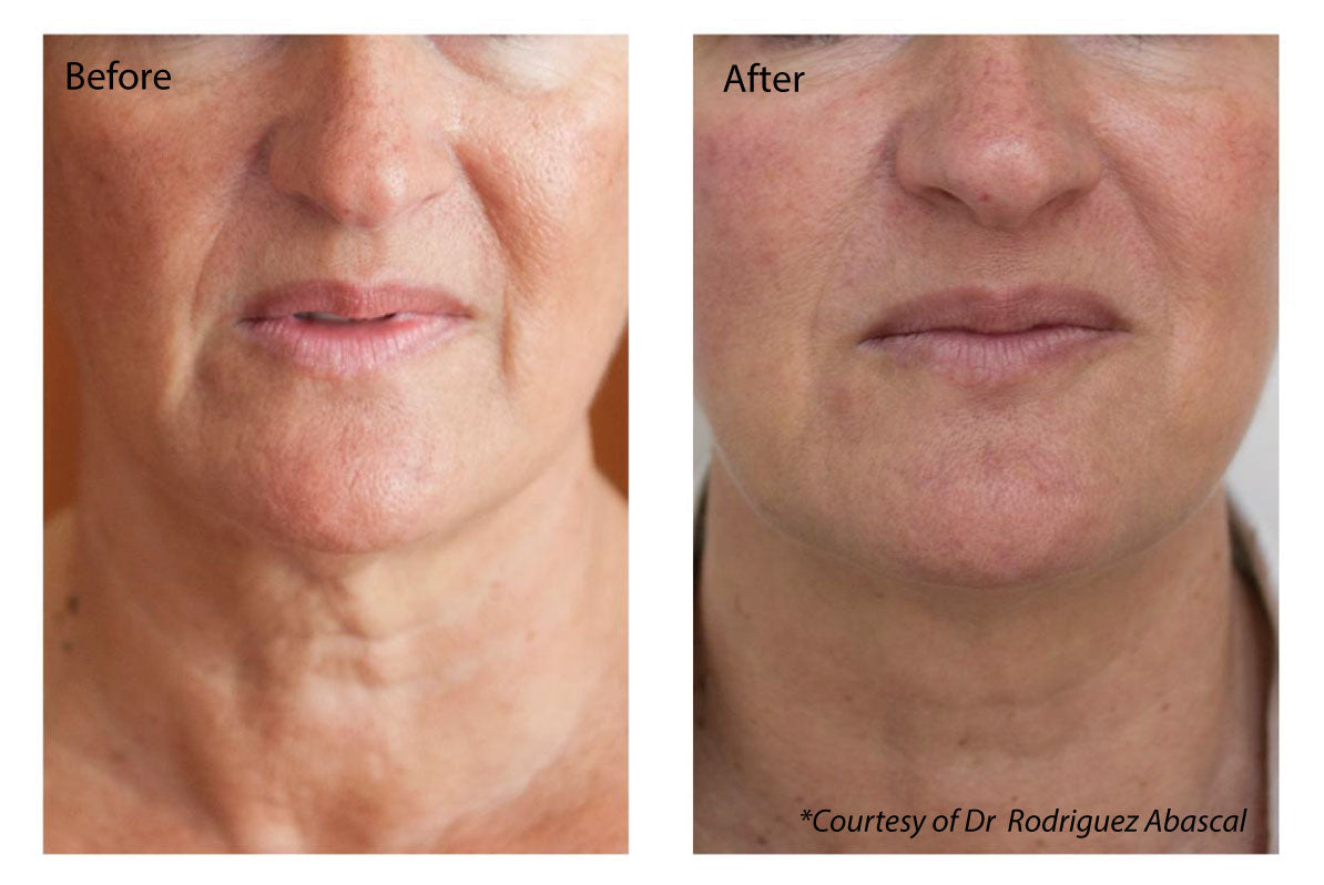 Profhilo Two Treatments +1ml Lip Filler (save €151)