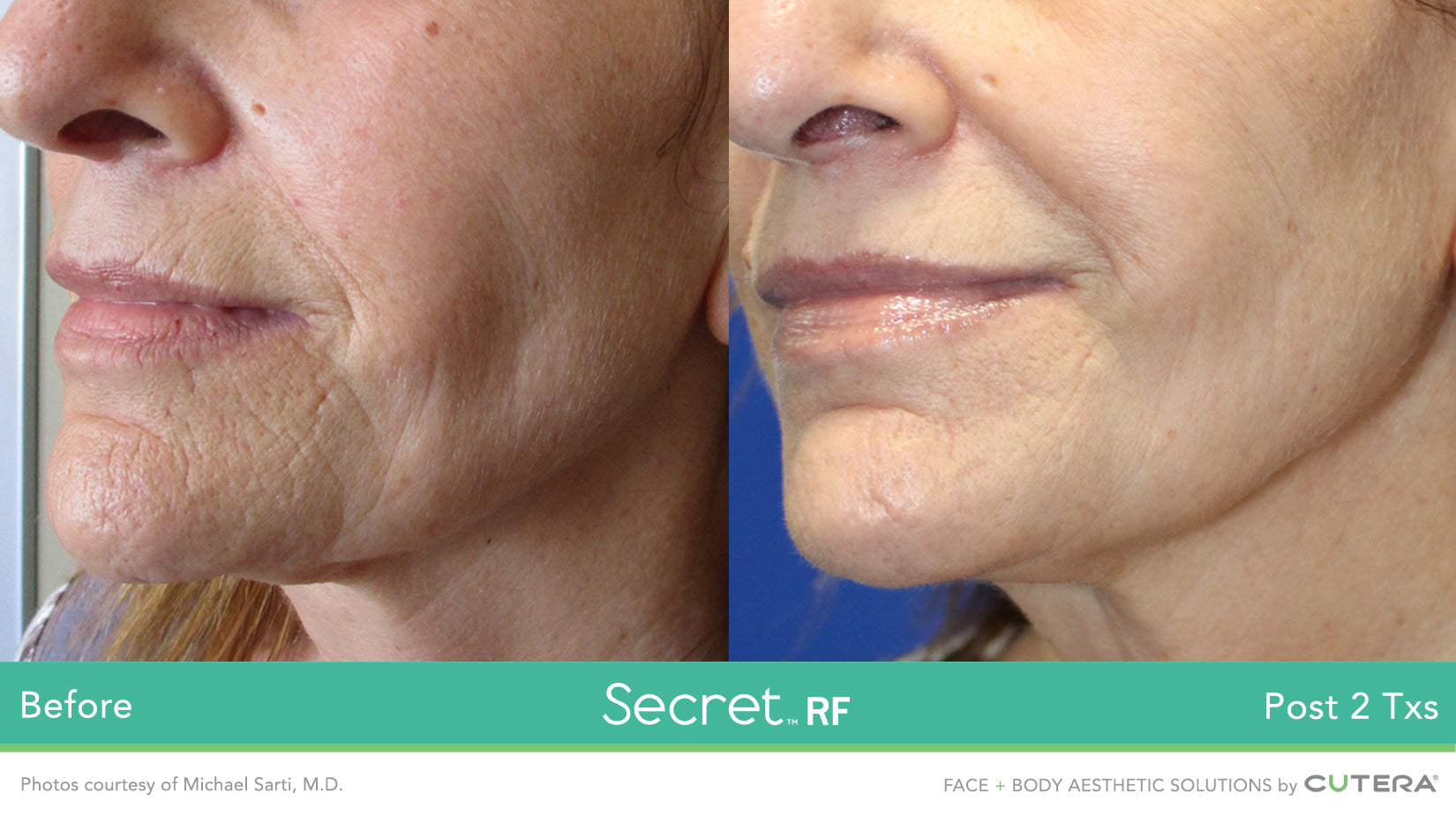 Cutera Secret RF +Microneedling Course of 3 with optional Exosomes (save up to €1,001)