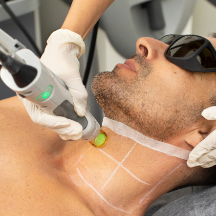 Laser Hair Removal Men's Facial Hair Package (as low as €59.90 per session)