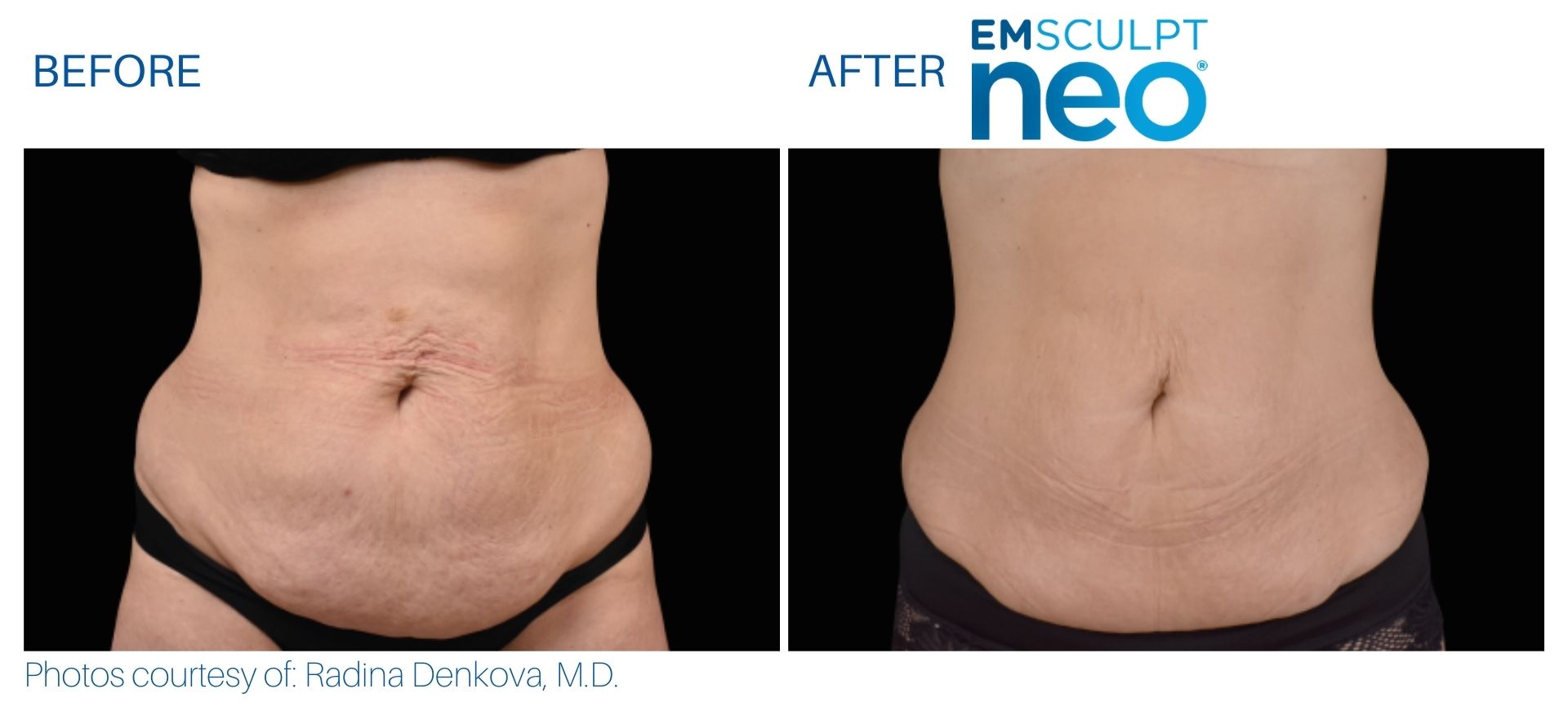 EmSculpt Classic for Muscle Building Single Session One Area