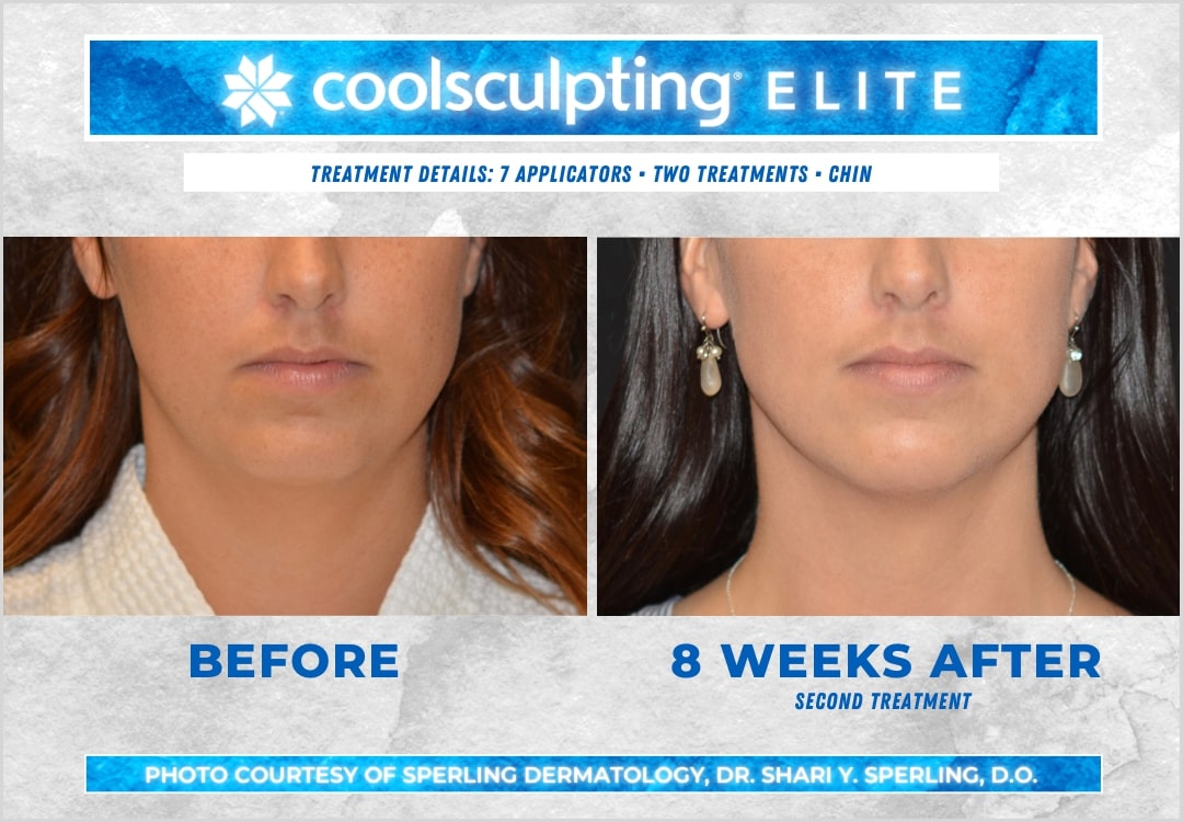CoolSculpting Elite Chin Fat Package (save €1,151)