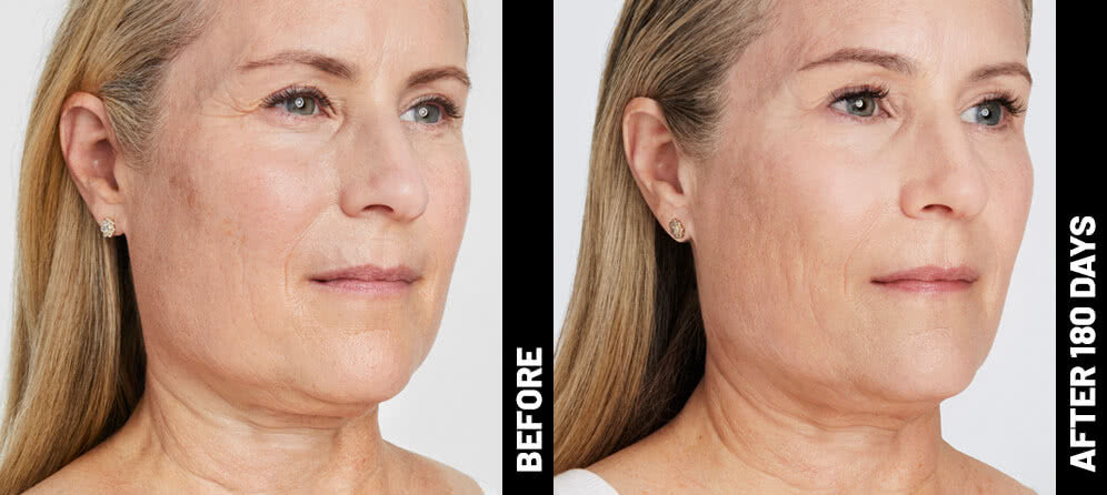 Ultherapy Non-Surgical Face Lift Package for lower face and jawline with complimentary HydraFacial (save €550)