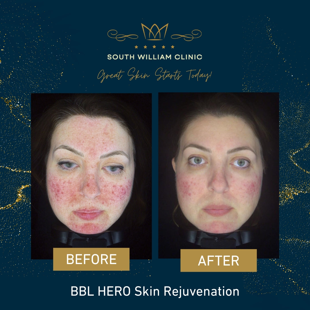 BBL HERO Skin Rejuvenation Single Treatment for Face, Neck or Décollet