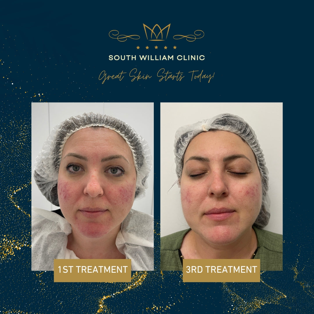 South William Stax: BBL HERO + HALO Skin Resurfacing Package (save €1,201)