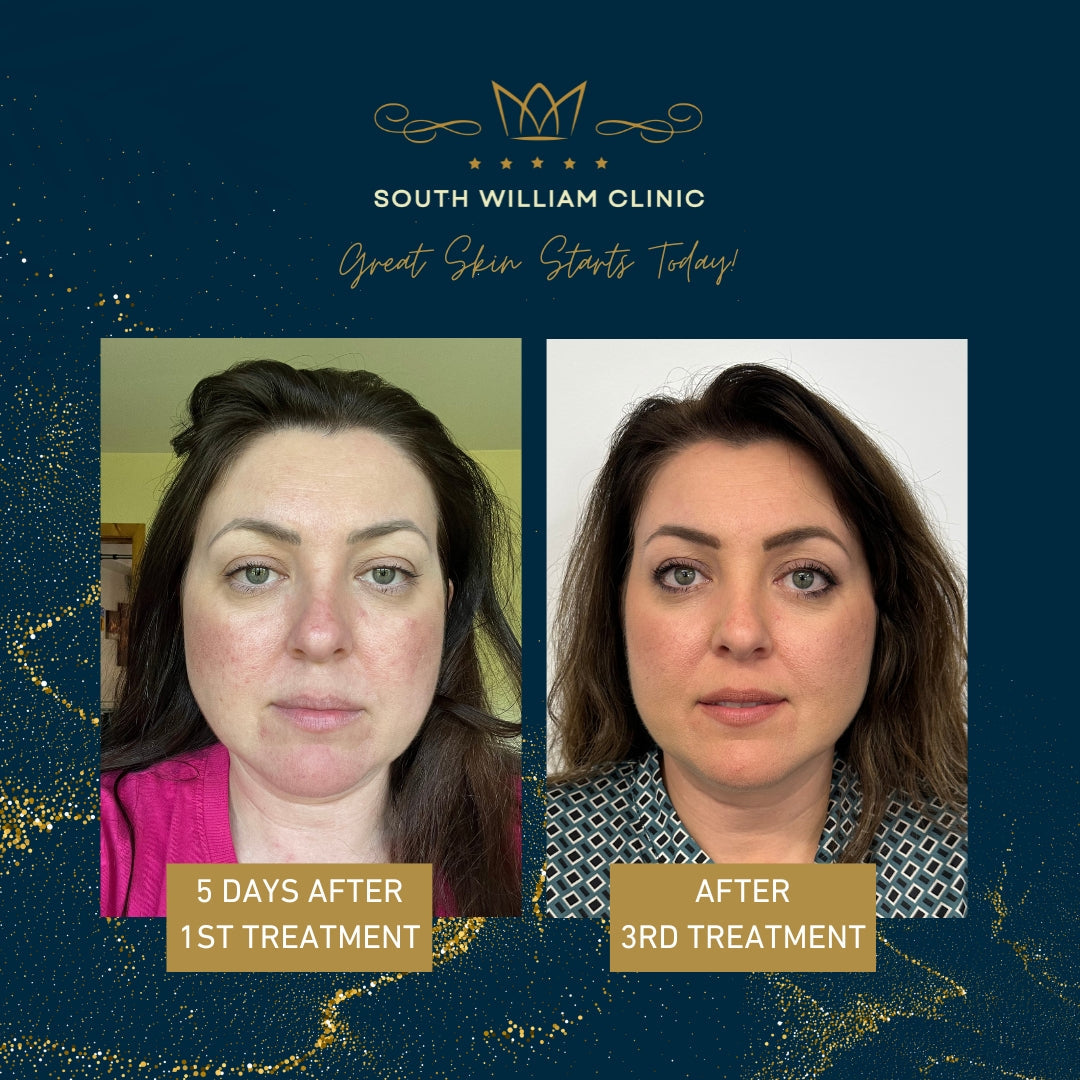 BBL HERO Photofacial Skin Rejuvenation for Face, Neck & Décolleté Course of 4 (save €500)