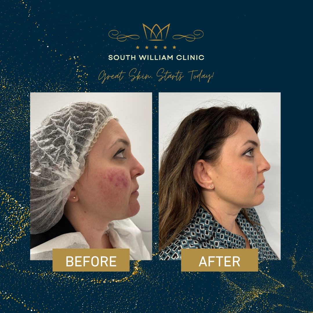 South William Stax: BBL HERO + HALO Skin Resurfacing Package (save €1,201)