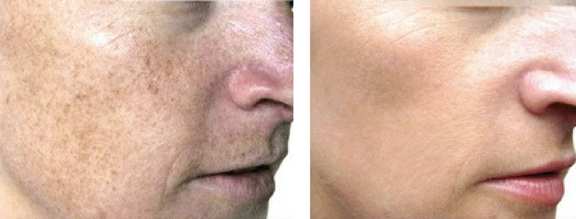 BBL HERO Laser Skin Rejuvenation Course of 3 (save up to €501)