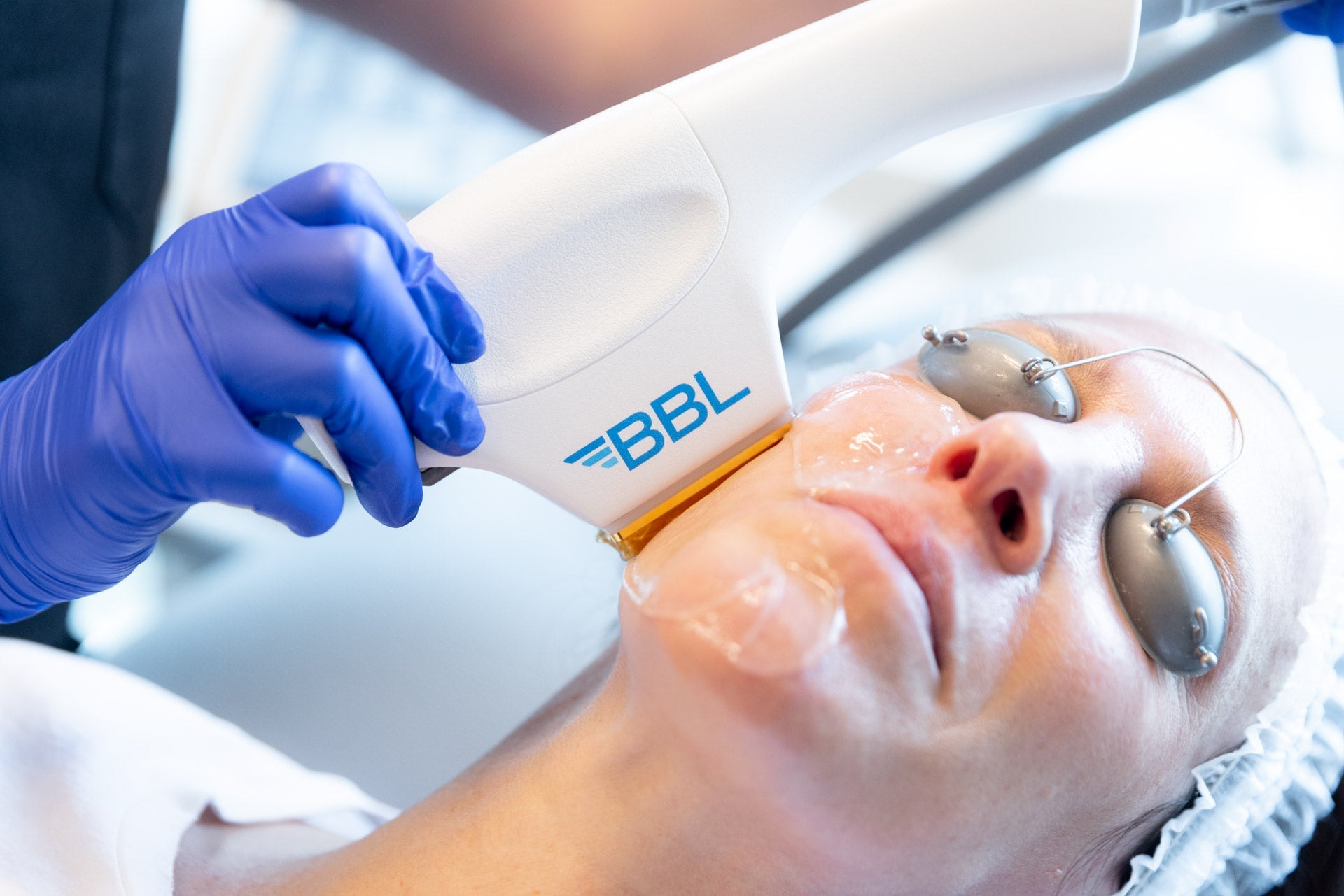 Platinum Skin Rejuvenation Pack: BBL + MOXI + Microneedling + Peels for Face & Neck Course of 3 (save €2,001)