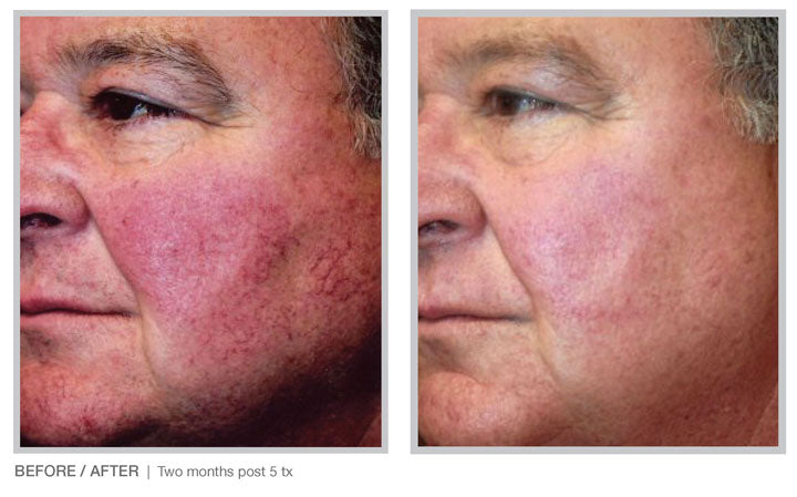 BBL HERO Laser Skin Rejuvenation Course of 3 (save up to €501)