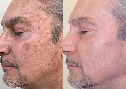 HALO Laser Skin Resurfacing Package for Face & Neck Course of two (save €1,000)