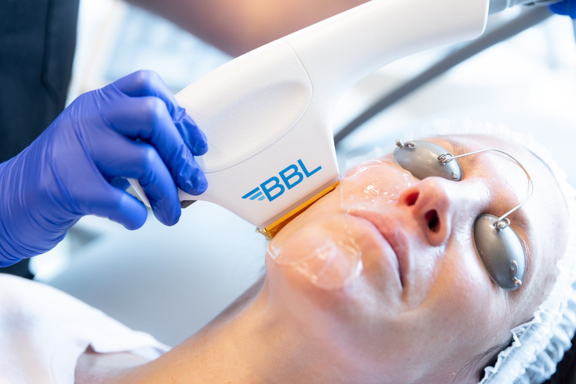 NEW South William Clinic Signature Five Step Advanced Facial: HydraFacial, BBL Laser, Microneedling, Uber Peel, LED Light Therapy