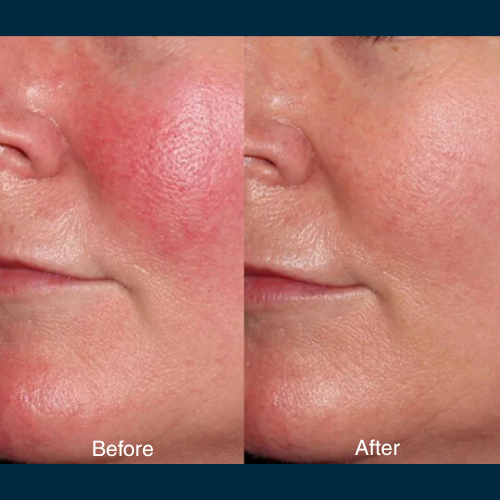Summer Six Radiance Reset: BBL + Obagi Blue Peel (save up to €651)