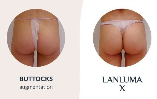 Lanluma Bum Transformation Package (save €1,050)