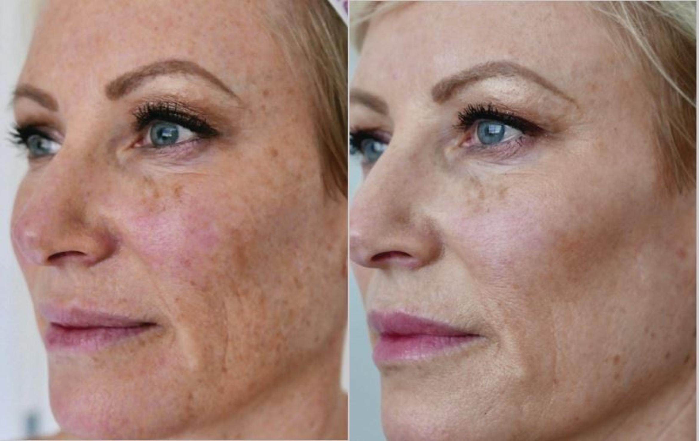 HALO Laser Skin Resurfacing Package for Face & Neck Course of two (save €1,000)