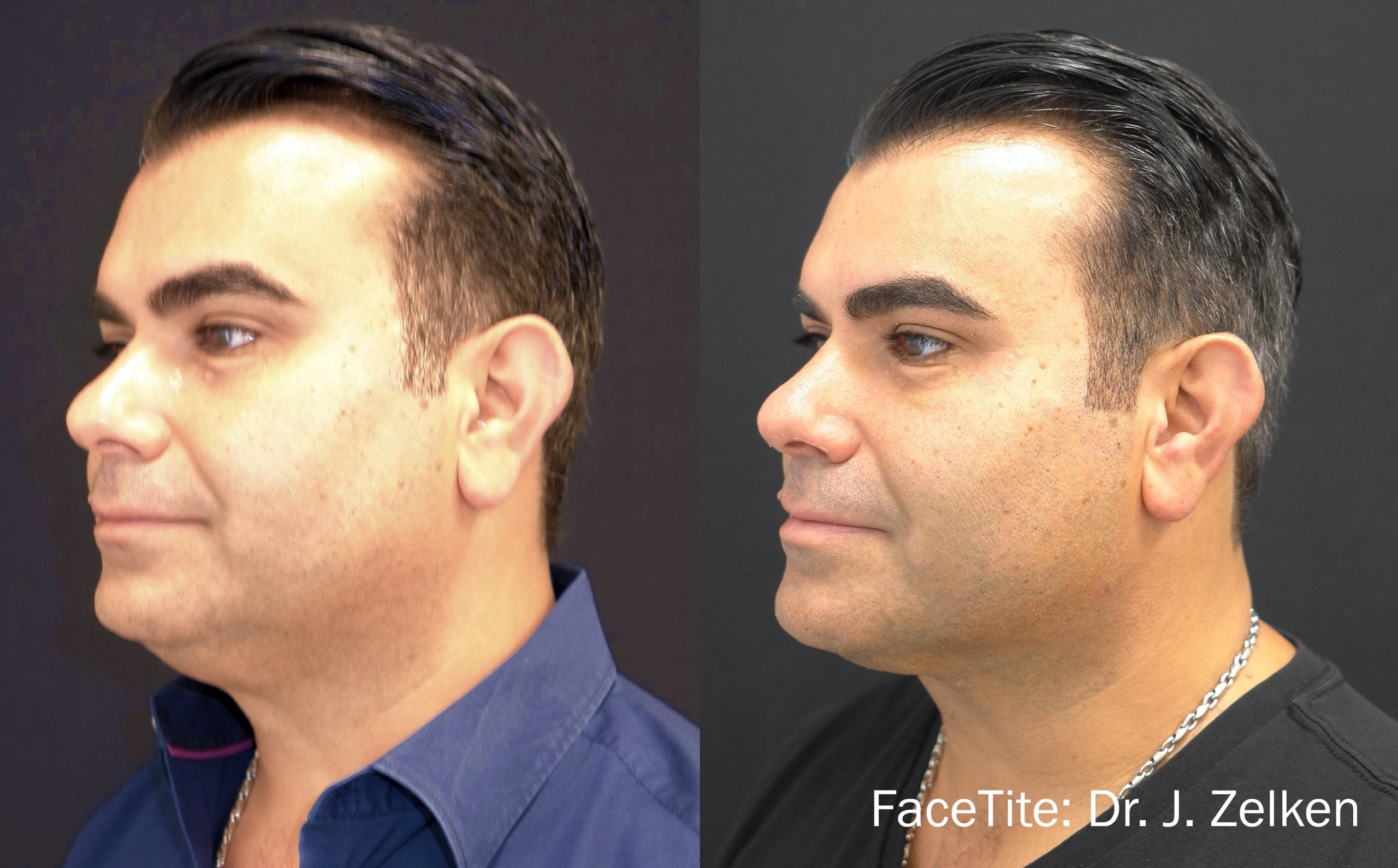 NEW FaceTite by InMode Fat Reduction & Skin Tightening +FREE Morpheus8 RF Microneedling (save €801)