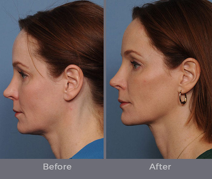 NEW FaceTite by InMode Fat Reduction & Skin Tightening +FREE Morpheus8 RF Microneedling (save €1,401)