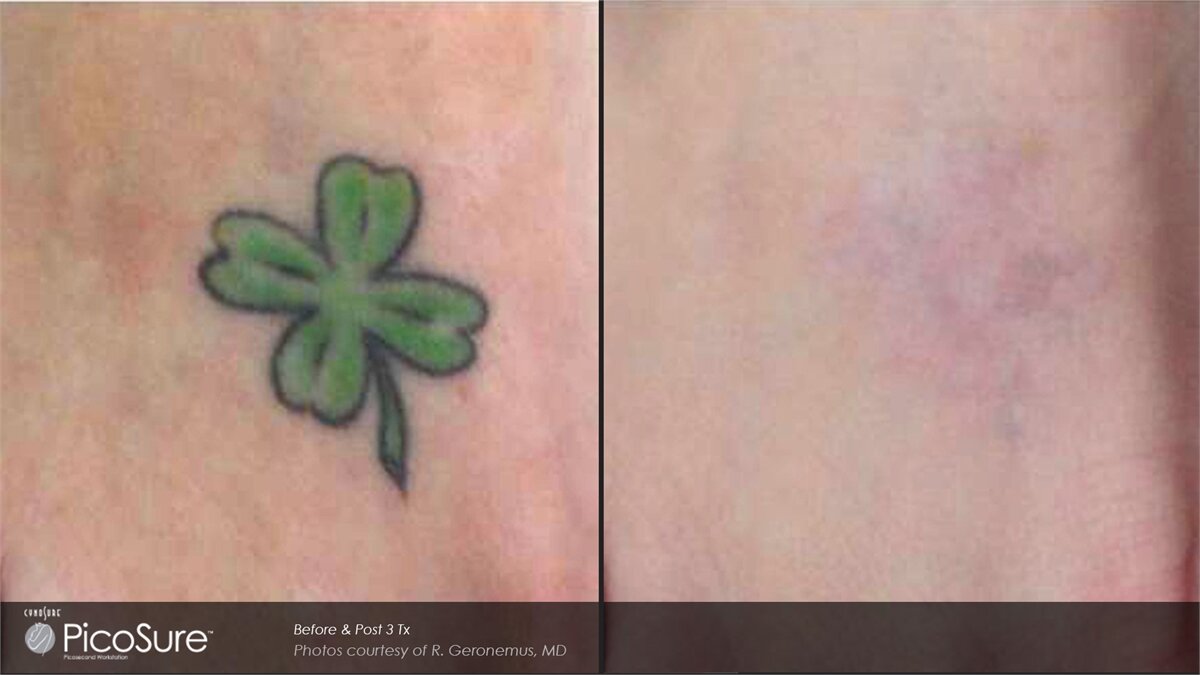NEW Picosure Laser Tattoo Removal save up to €501