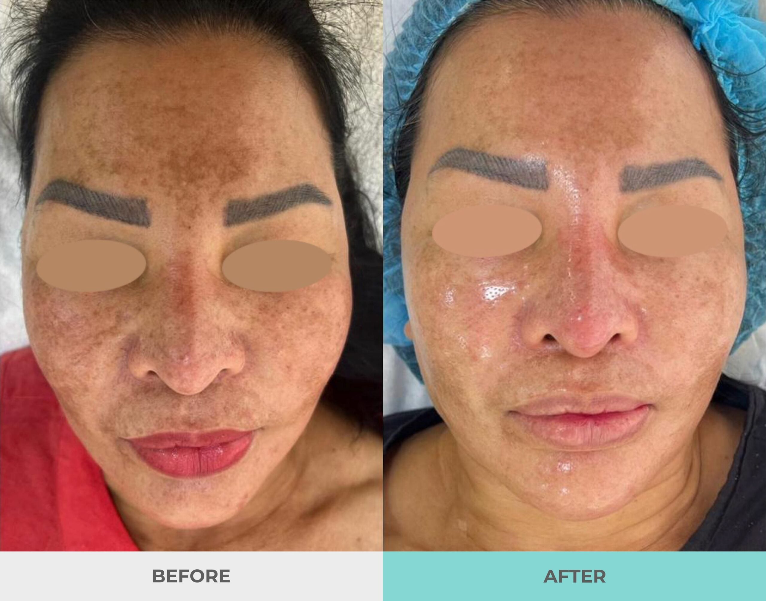 Purasomes Exosome Treatment for face or scalp (save up to €356)