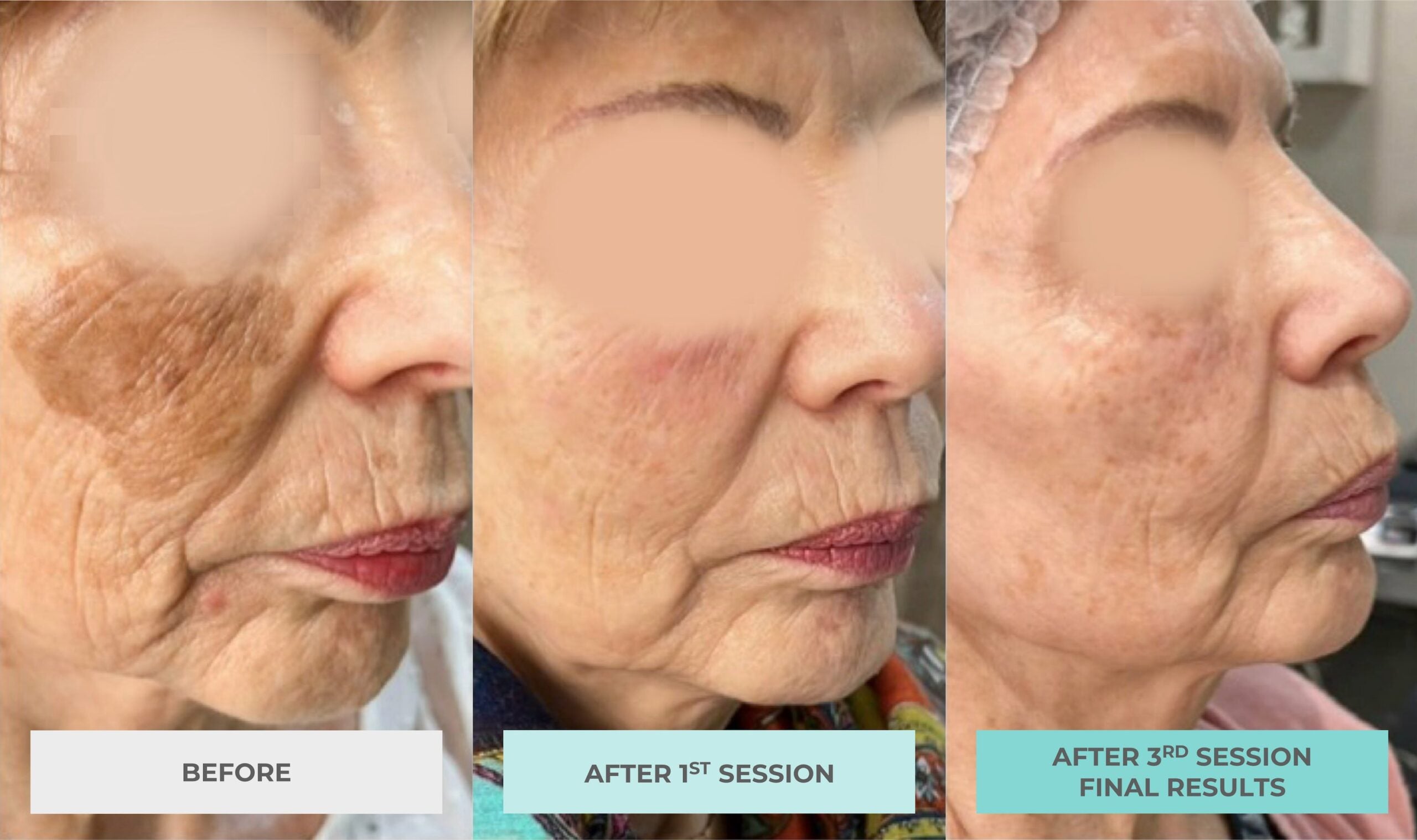 Purasomes Exosome Treatment for face or scalp (save up to €356)