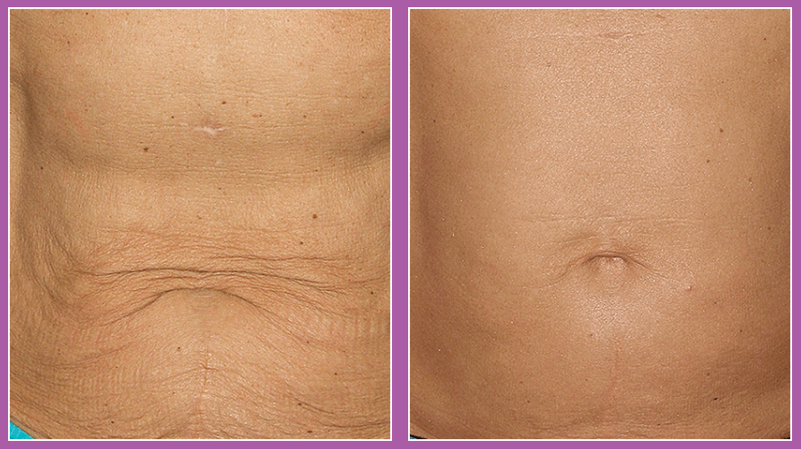 Thermage FLX RF Anti-Ageing Skin Tightening Treatment save up to €2,001