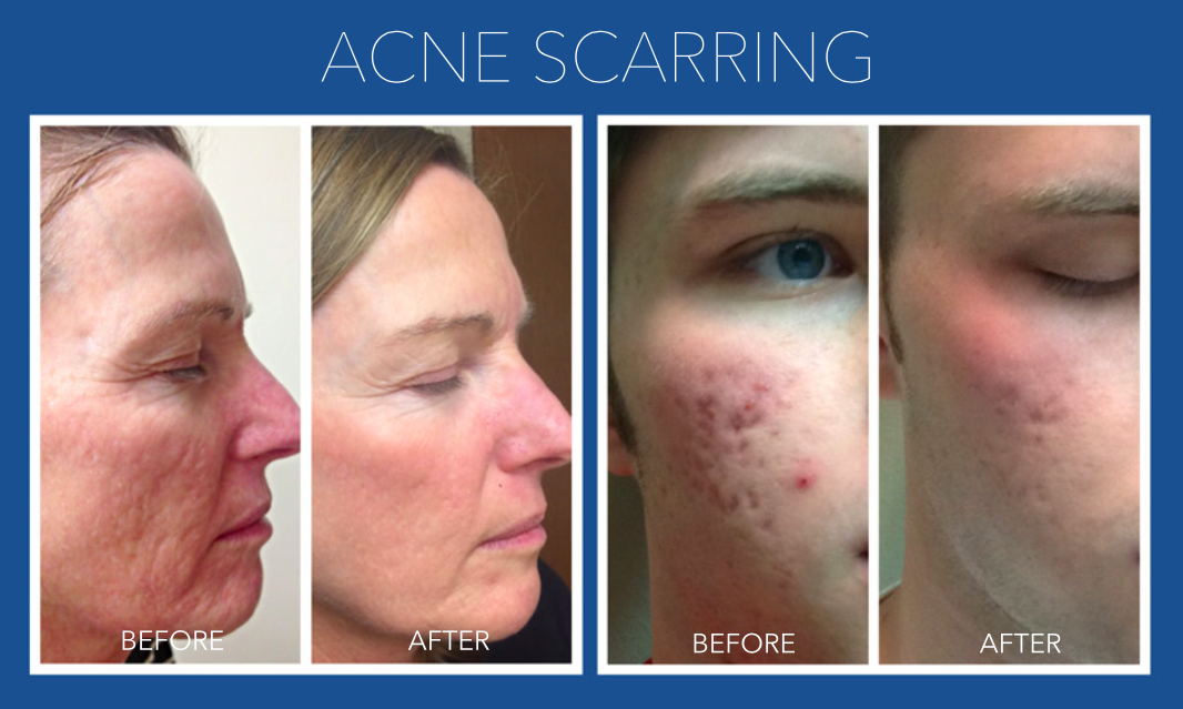 Microneedling with LED Light Therapy Course of 3 (save up to €456)
