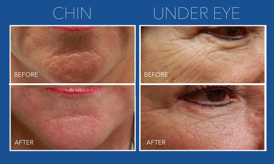 Dermapen Deluxe Microneedling with Uber Peel & LED Course of 3 (save €341)