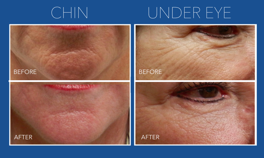 Dermapen Microneedling Package with LED Light Therapy Course of 3 (save €291)