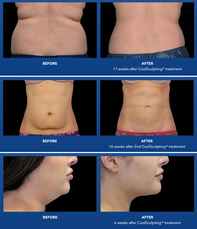 CoolSculpting Elite Chin Fat Package (save €1,151)