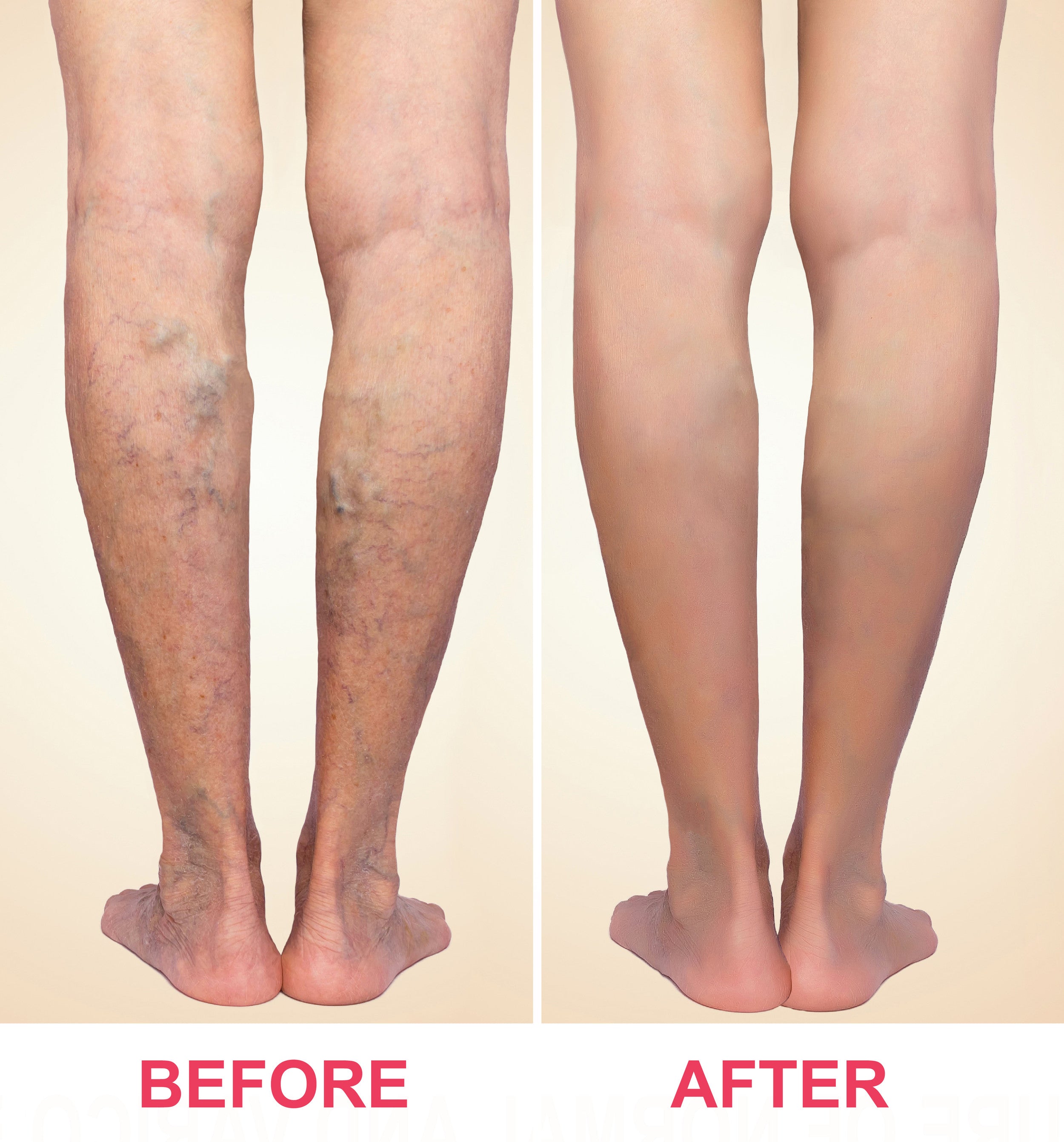 Sclerotherapy vein reduction injections course of 4 (save up to €601)
